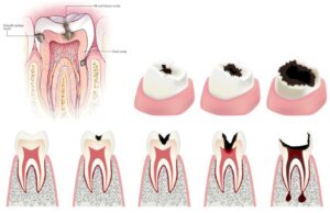 Cavities (Tooth Decay